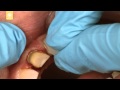 Temporary Veneer Placement & Removal with ClearTemp LC