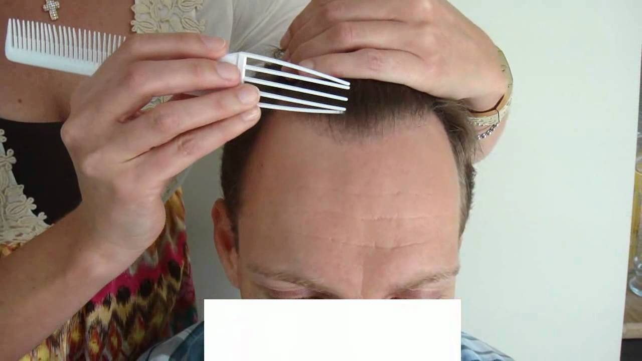 Hairline lowering hair transplant - YouTube