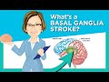 I CARE FOR YOUR BRAIN Basal Ganglia Stroke