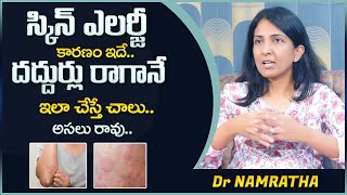 Dr Namratha : Skin Allergy Treatment At Home | Skin Rashes Symptoms, Treatment & Causes | Mr Nag