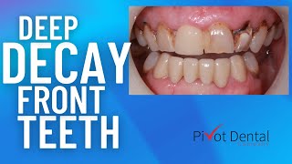 Anterior decay and fixing with crowns