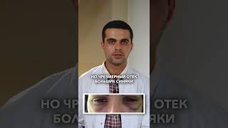 Шон   отек после блефаропластики
