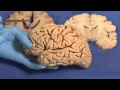 Limbic neuroanatomy lab  brain dissections