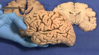 Limbic: Neuroanatomy Video Lab - Brain Dissections