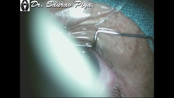 CORTICAL CLEAVING HYDRODISSECTION IN SICS - Dr. Saurav Piya