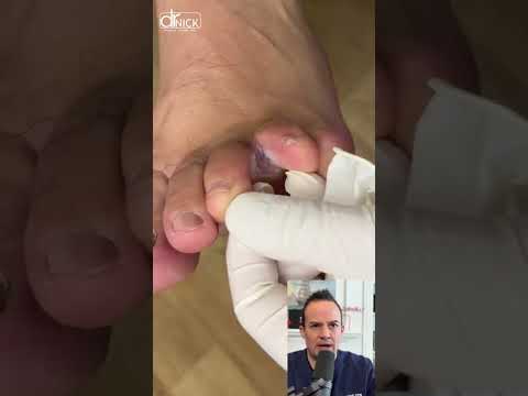 DOCTOR REACTS: FUNGUS🍄 INFECTION BETWEEN TOES!😱 #shorts #reaction