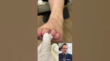 DOCTOR REACTS FUNGUS INFECTION BETWEEN TOES Shorts Reaction 