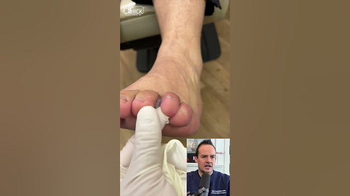 DOCTOR REACTS: FUNGUS🍄 INFECTION BETWEEN TOES!😱 #shorts #reaction