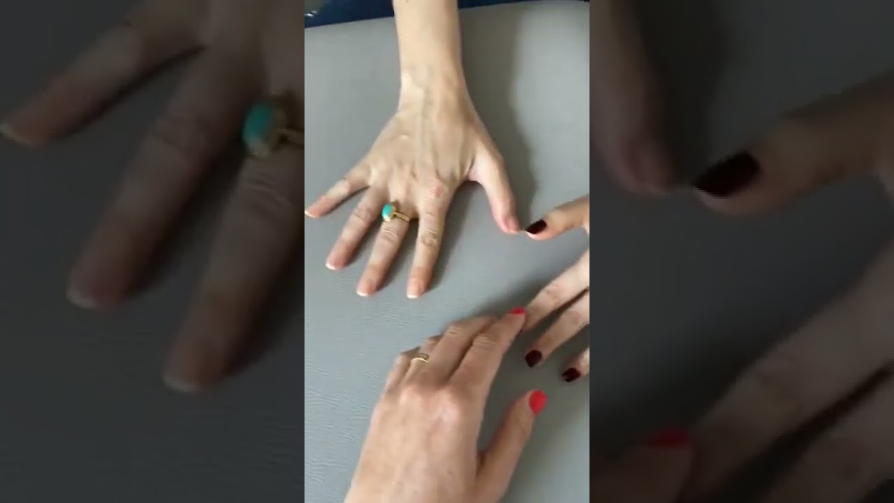 Cas clinique d'une patient avec un SDRC sévère