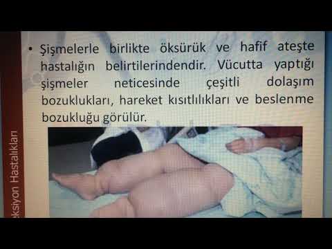 Video: Lenfatik Filaryaz Nasıl Tanınır ve Önlenir: 12 Adım