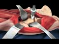Direct Anterior Approach Hip Replacement