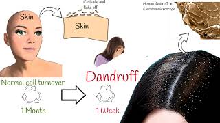 Dandruff  explained in under 2 minutes. Dandruff  Causes and Treatment