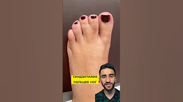 девушка лягушка? или срощенные пальцы на ногах