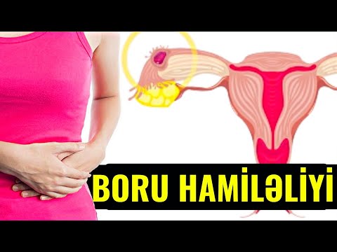 Boru Hamiləliyini Müalicəylə Matkaya Salmaq Mümkündürmü?