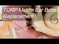 Middle ear bone total replacement  total ossicular replacement prosthesis torp for hearing loss