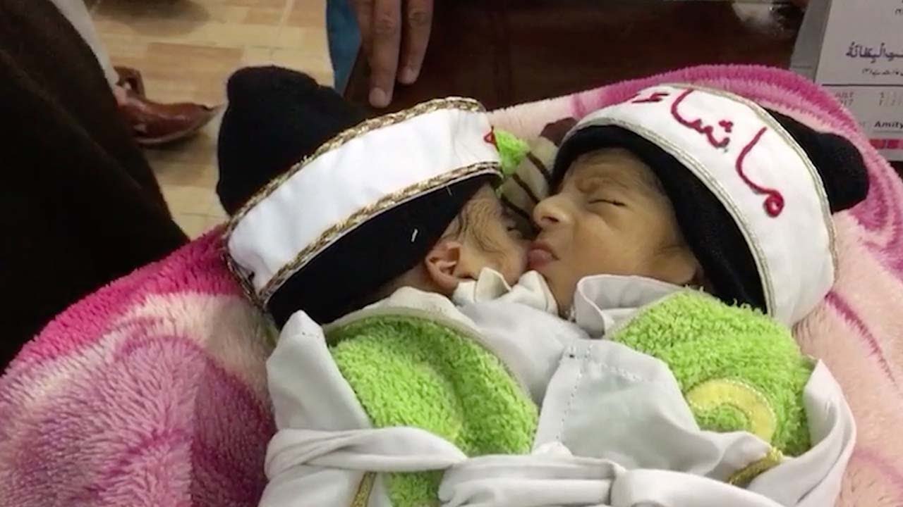 Newborn pakistani twins conjoined at abdomen