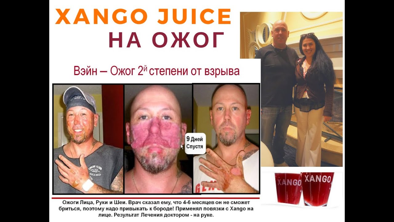 Xango Juice при ожоге