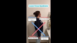 Upper and Lower Cross Syndrome