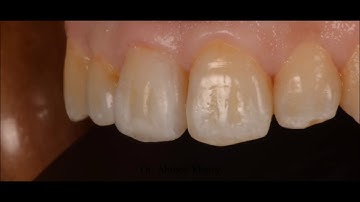 Class IV Composite Restoration