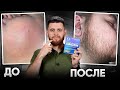 РЕЗУЛЬТАТ КСИНОКСИНА для роста бороды / С НУЛЯ ЗА 3 МЕСЯЦА