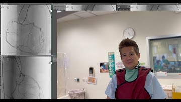 Using Angiographic 3D Antegrade Penetration Technique (ADAPT) for CTO body wiring CTO demon demo!!