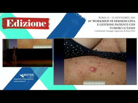 X Workshop - A. Lallas - Update su non-melanoma skin cancer