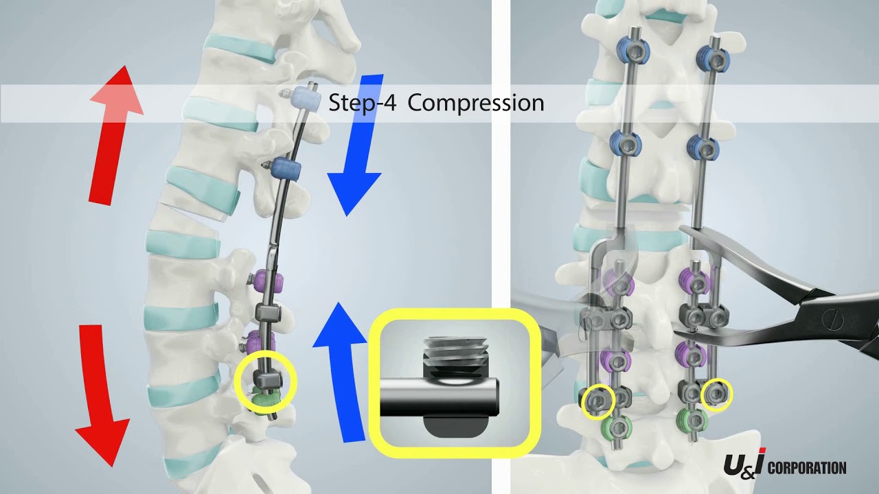 Lumbar Level Extension Device Perfix LED Surgical Tech - YouTube