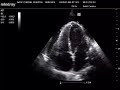 Effusive Constrictive Pericarditis