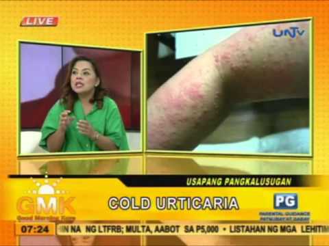 Video: Paano Magamot ang Whitlow (Herpes on Fingers) (na may Mga Larawan)