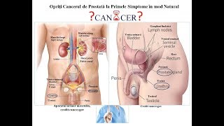 Adenom de prostata: cauze, simptome, complicatii, tratament | Bioclinica