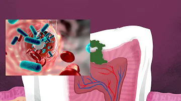 Como matar a Streptococcus mutans?