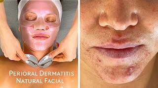 ASMR Rosacea & Inflamed Perioral Dermatitis Acne Facial  Jadeywadey180