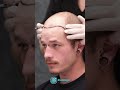 Hair transplant surgery  using the latest technology  techniques