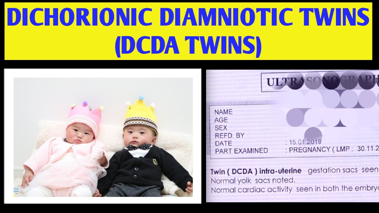 DCDA TWIN PREGNANCY IN HINDI DCDA TWINS MEANING, 56 OFF