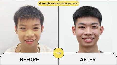Niềng răng sớm - Cho con nụ cười rạng ngời, tỏa sáng mọi nơi #dentist #niengrang