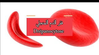 drépanocytoseكريات الدم الحمراء على شكل منجل أو هلال !فقر الدم المنجلي