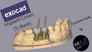 How To Design An Implant Crown (Ti-Base)