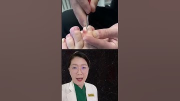 Review - Móng mọc ngược làm sao hết? #thsbsphuongquy #review #reaction #shorts