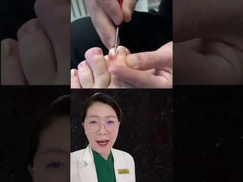 Video: 3 cách để ngăn ngừa móng tay mọc ngược