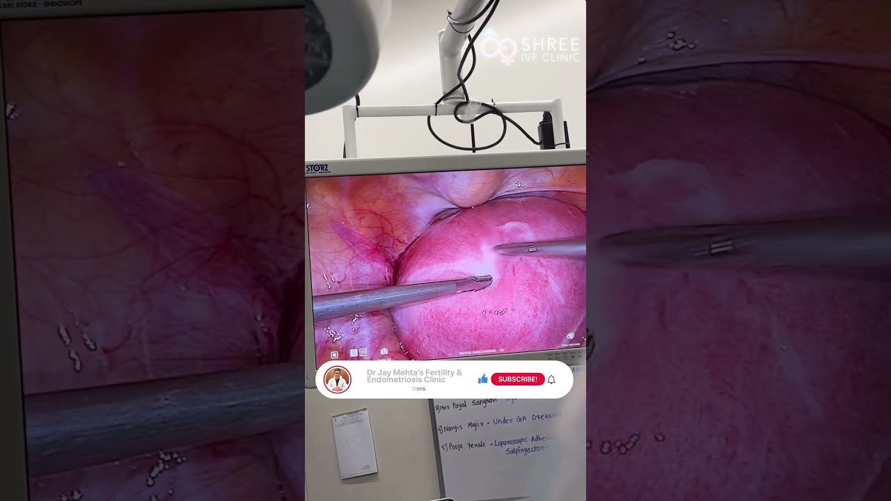 Case 600 Treating Adenomyosis With Microwave Ablation Dr Jay Mehta Shree IVF Clinic