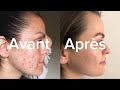 **Soin de la peau 100 % naturel qui vous rend belle en seulement 7 jours.**#remedenaturel #astuc