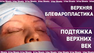 Убрать МЕШКИ под глазами БЕЗ РАЗРЕЗОВ. Подтяжка век. Блефаропластика.