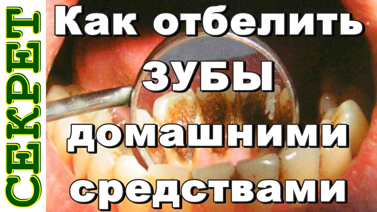 Чем отбелить зубы дома