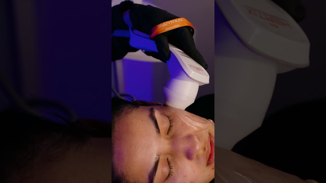 RADIOFREQUENCIA TRATANDO CICATRIZ DE ACNE