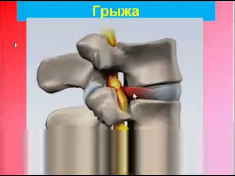 Грыжи диска оперировать нельзя!