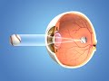 Johnkenyon cataract removal  dr piracha