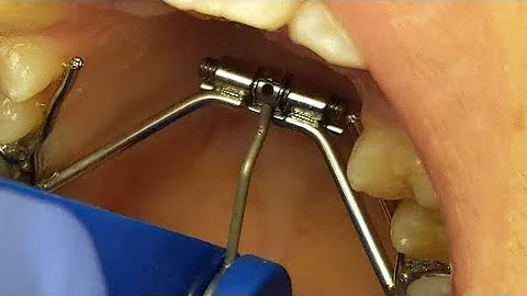 How to Turn Your Palatal Expander: Explanation and Patient Demonstration from The Ranch Orthodontics