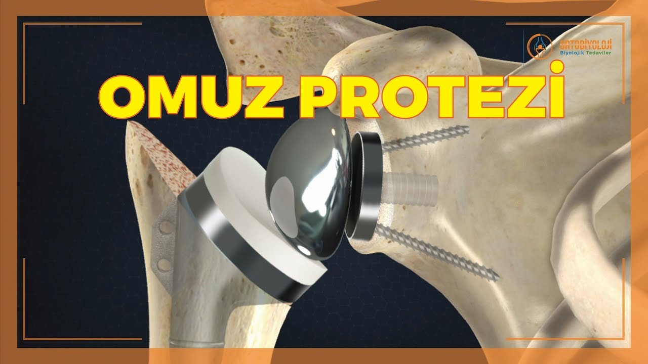OMUZ PROTEZİ TEDAVİSİ