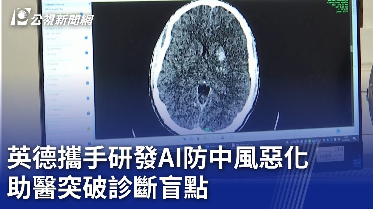 英德攜手研發AI防中風惡化助醫突破診斷盲點｜ 公視新聞網PNN