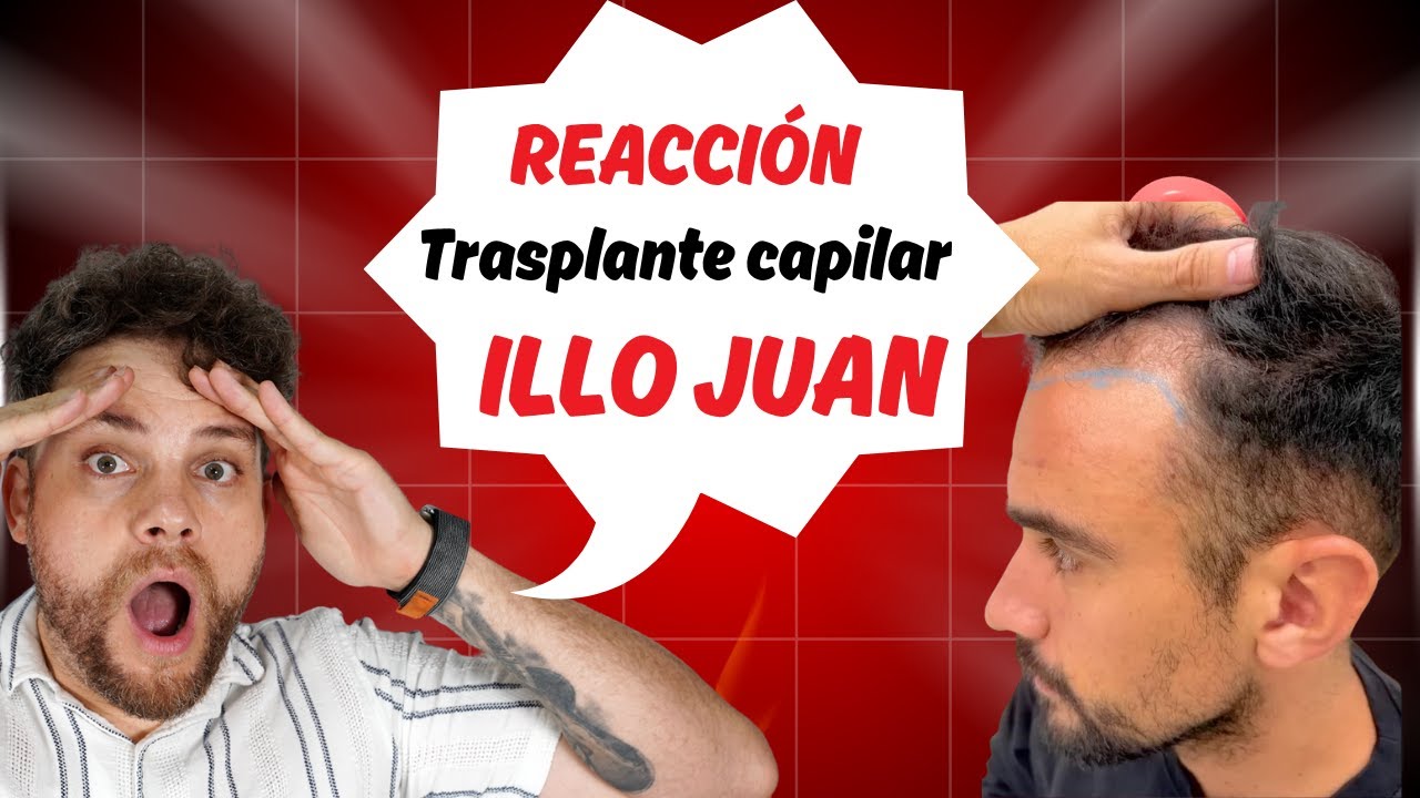 ¿Trasplante capilar preventivo? Analizo el caso de Illo Juan y lo que le han contado en la clínica…